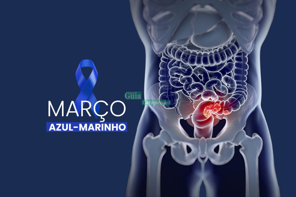 Março Azul Marinho: fatores genéticos são a causa de 20% dos casos de câncer colorretal