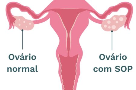 Setembro: Mês da conscientização sobre a Síndrome de Ovários Policísticos